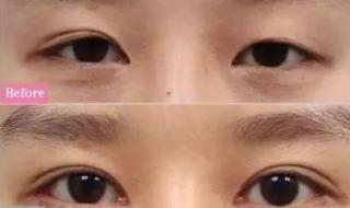 眼皮下垂解决方法